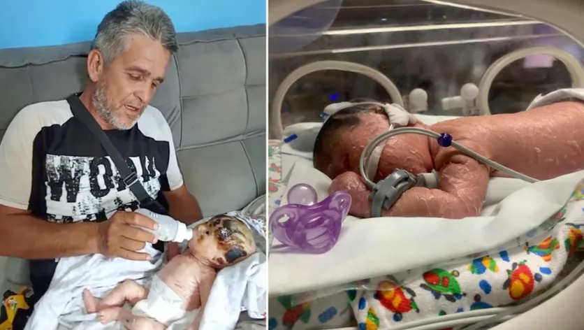 João Guilherme, bebê de 3 meses com ictiose — família busca apoio para manter o tratamento diário